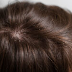 How to Stop Skin Picking: A Comprehensive Guide