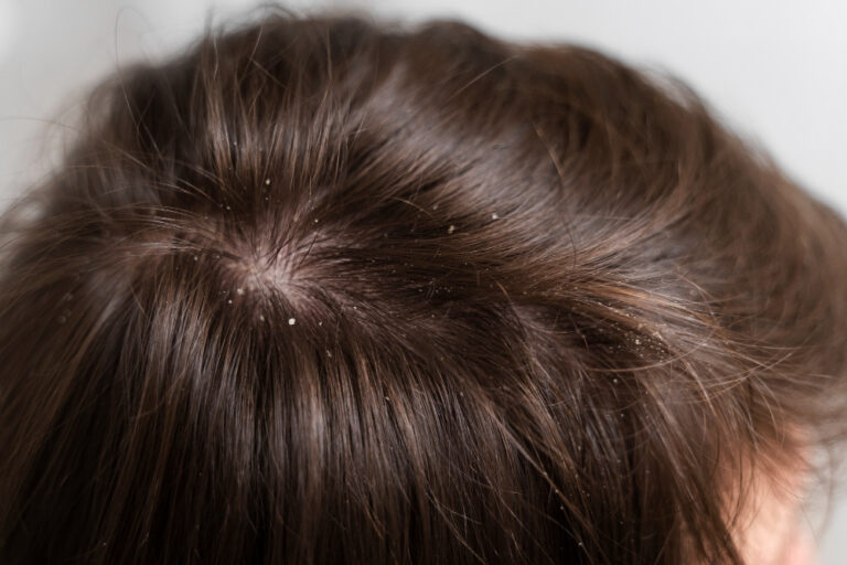 How to Get Rid of Dandruff: A Comprehensive Guide