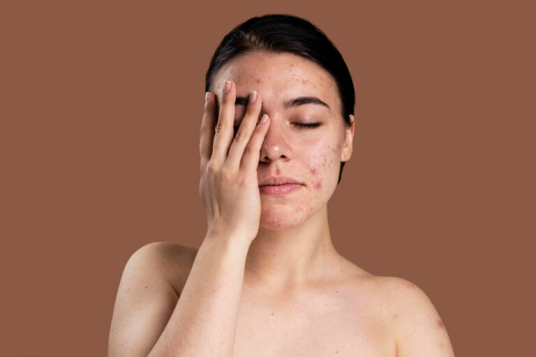 How to Remove Acne Scars Naturally
