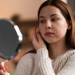 Hormonal Acne: Causes, Symptoms, and Effective Solutions