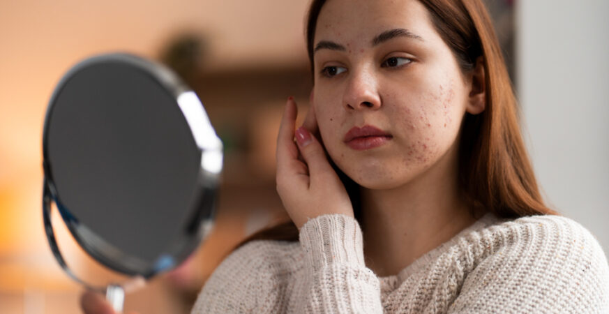 Hormonal Acne: Causes, Symptoms, and Effective Solutions