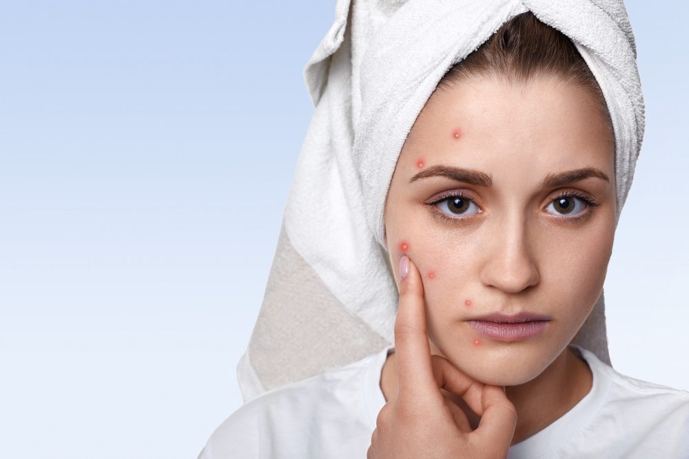 Hormonal Acne: Causes, Symptoms, and Effective Solutions